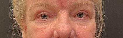 Eyelid Surgery Before & After Patient #12246