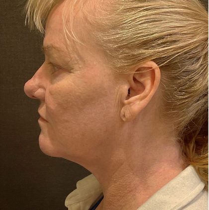 Necklift Before & After Patient #12239