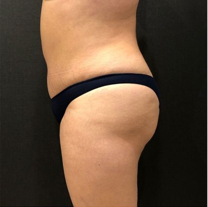 Fat Transfer to Butt Before & After Patient #12217