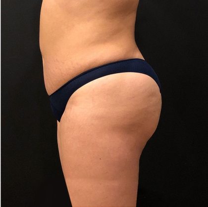 Fat Transfer to Butt Before & After Patient #12217