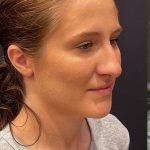 Rhinoplasty Before & After Patient #12227