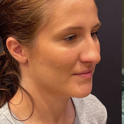 Rhinoplasty Before & After Patient #12227