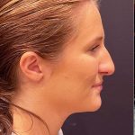 Rhinoplasty Before & After Patient #12227