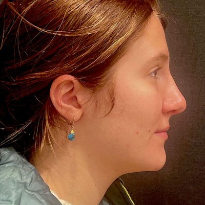 Rhinoplasty Before & After Patient #12227