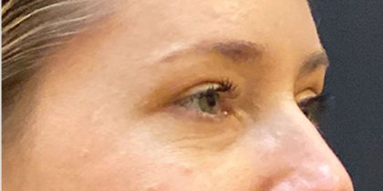 Eyelid Surgery Before & After Patient #12220