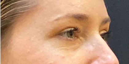Eyelid Surgery Before & After Patient #12220