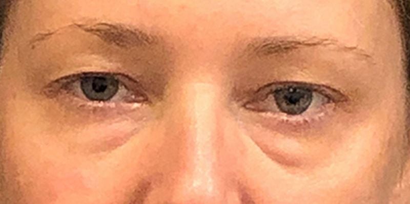 Eyelid Surgery Before & After Patient #12220