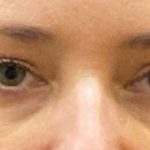 Eyelid Surgery Before & After Patient #12220