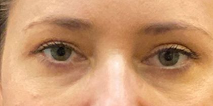 Eyelid Surgery Before & After Patient #12220