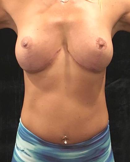 Liposuction Before & After Patient #12298