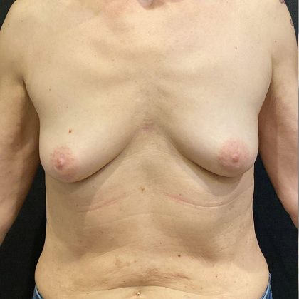 Breast Augmentation Before & After Patient #12305