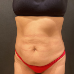 Liposuction Before & After Patient #12327