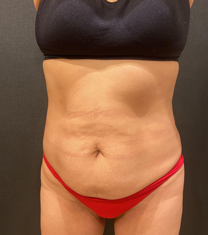 Liposuction Before & After Patient #12327