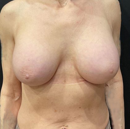 Breast Augmentation Before & After Patient #12305