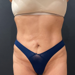 Liposuction Before & After Patient #12327