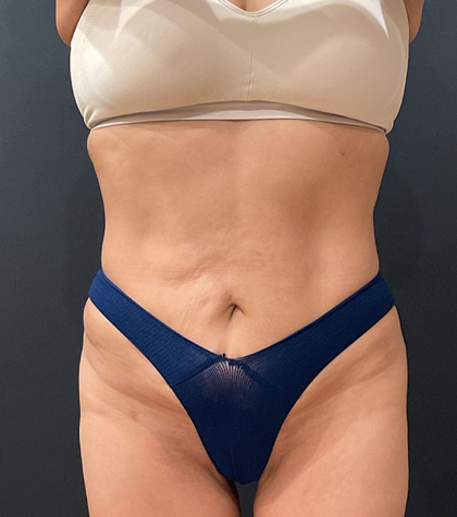 Liposuction Before & After Patient #12327