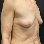 Breast Augmentation Before & After Patient #12305