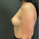 Breast Augmentation Before & After Patient #12314