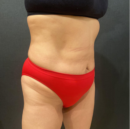 Liposuction Before & After Patient #12327