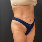 Liposuction Before & After Patient #12327