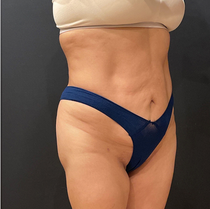 Liposuction Before & After Patient #12327