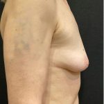 Breast Augmentation Before & After Patient #12305