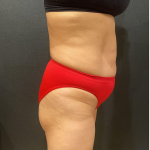 Liposuction Before & After Patient #12327