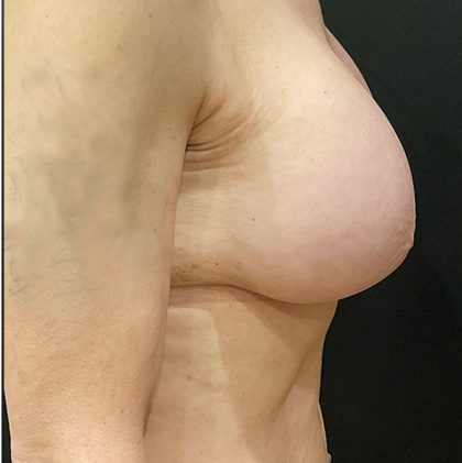 Breast Augmentation Before & After Patient #12305