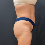 Liposuction Before & After Patient #12327