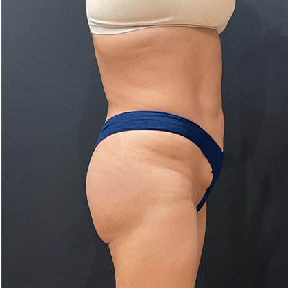 Liposuction Before & After Patient #12327