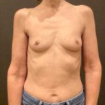 Breast Augmentation Before & After Patient #12384