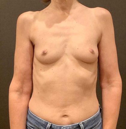 Breast Augmentation Before & After Patient #12384