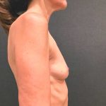 Breast Augmentation Before & After Patient #12384