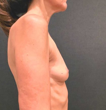 Breast Augmentation Before & After Patient #12384
