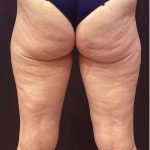 Thigh Lift Before & After Patient #12346