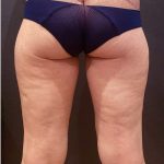 Thigh Lift Before & After Patient #12346