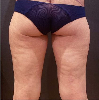 Thigh Lift Before & After Patient #12346