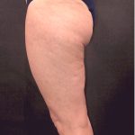 Thigh Lift Before & After Patient #12346