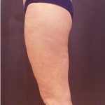 Thigh Lift Before & After Patient #12346