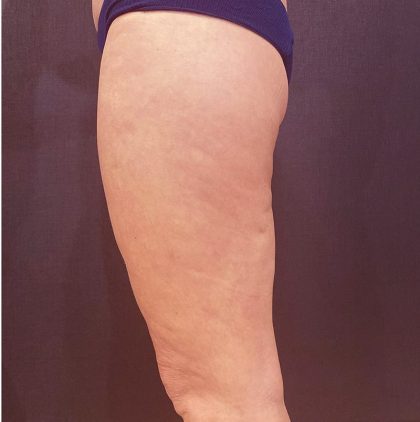 Thigh Lift Before & After Patient #12346