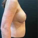 Breast Implant Removal Before & After Patient #12330
