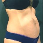 Tummy Tuck Before & After Patient #12351