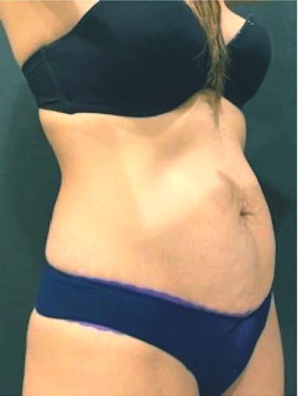 Tummy Tuck Before & After Patient #12351