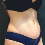 Tummy Tuck Before & After Patient #12351