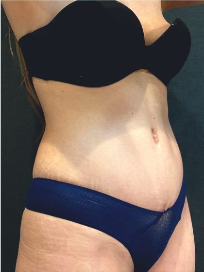 Tummy Tuck Before & After Patient #12351