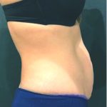Tummy Tuck Before & After Patient #12351