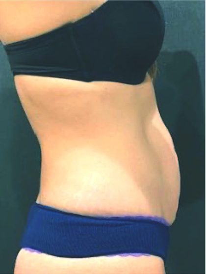 Tummy Tuck Before & After Patient #12351