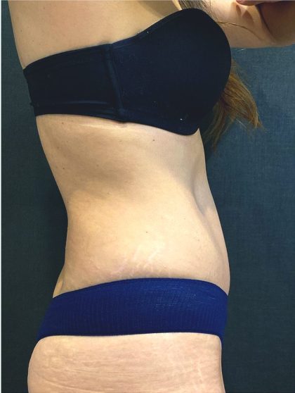 Tummy Tuck Before & After Patient #12351