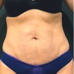 Tummy Tuck Before & After Patient #12351