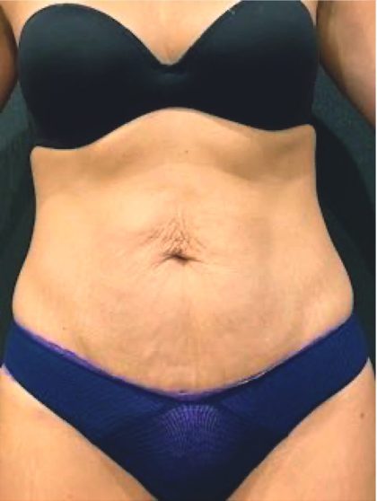 Tummy Tuck Before & After Patient #12351
